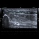 Baker's cyst, rupture: US - Ultrasound